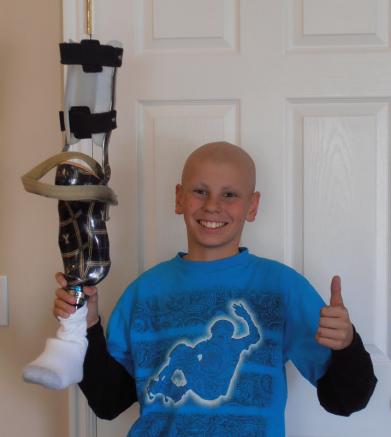 Tim holding his prosthesis after Van Ness Rotationplasty